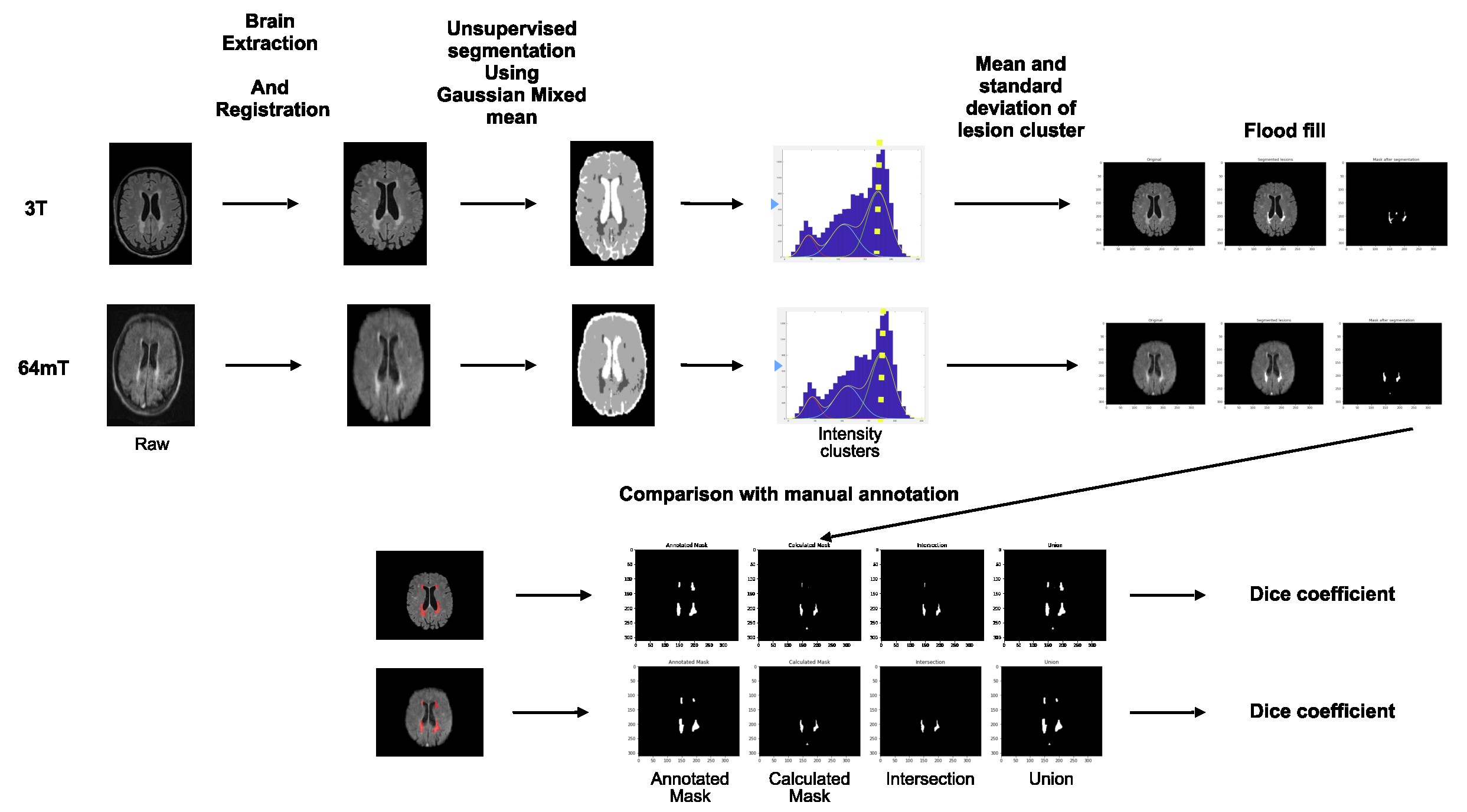 Computer Vision for MS Lesion Detection in Portable MRI