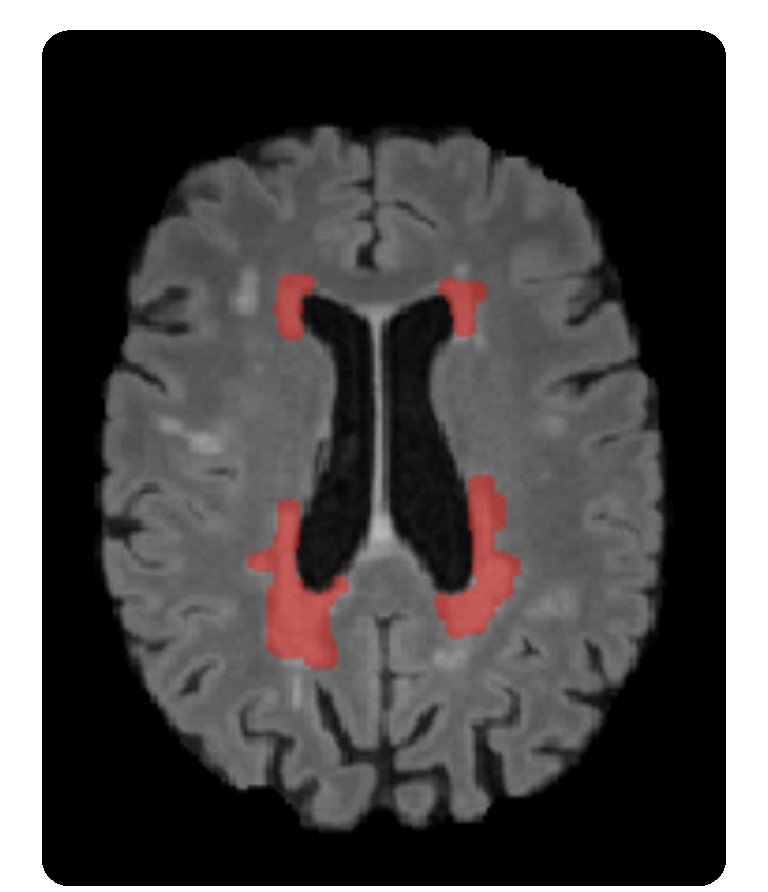 Computer Vision for MS Lesion Detection in Portable MRI